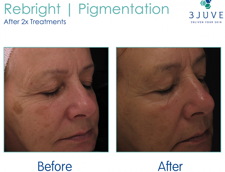 Pigment removal before and after