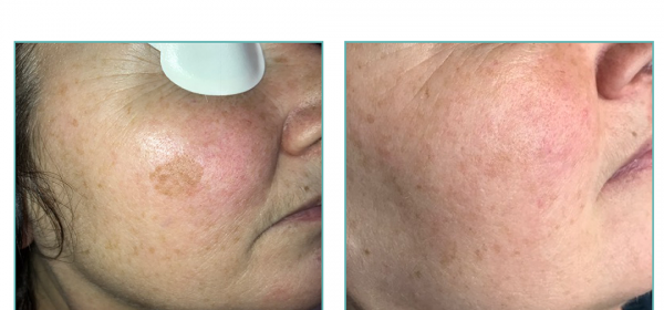 Pigmentation removal before and after