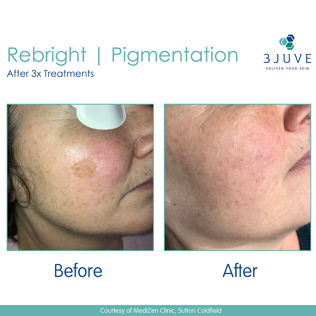 What Is the Best Laser Treatment for Pigmentation Removal? 