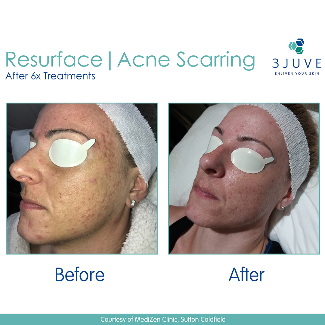 Why Fractional Laser Treatment Is the Gold Standard for Acne Scarring