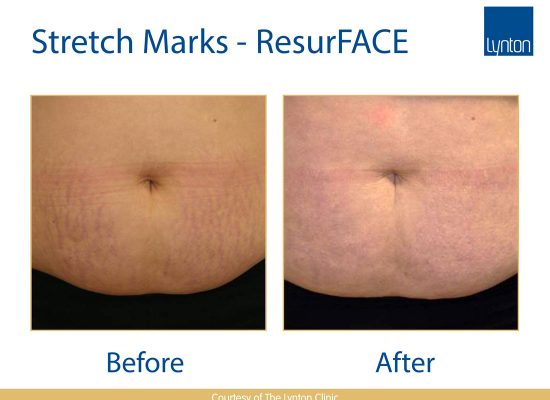 How to get rid of Stretch Marks