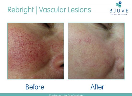 Vascular Lesions / Red Veins Before & After Treatment