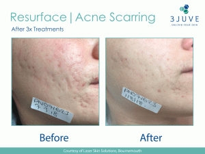 Fractional laser acne scarring before and after