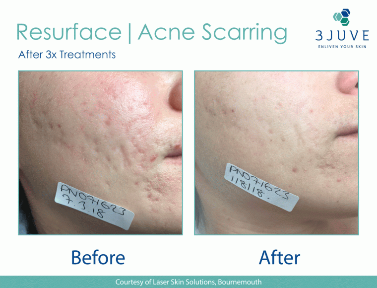 Acne Scar treatment Before and After