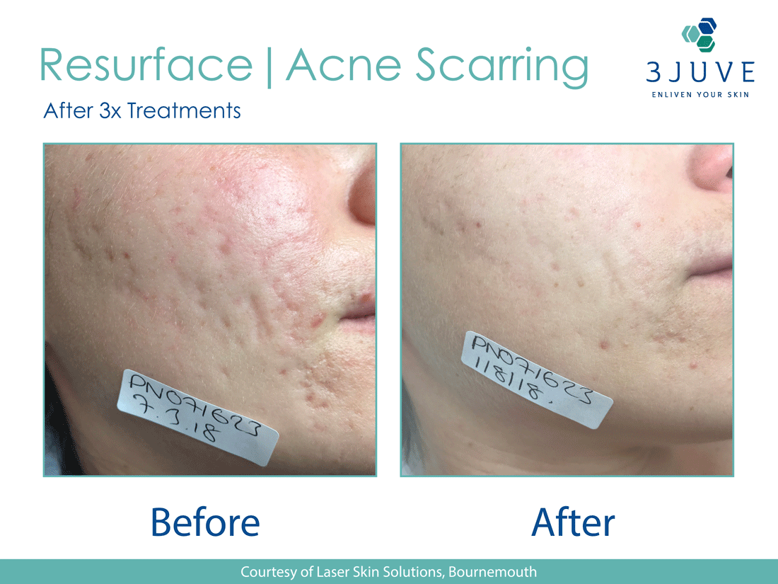 Can Fractional Laser Really Get Rid of Deep Acne Scars?