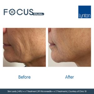 Before and After results of RF Microneedling Treatment
