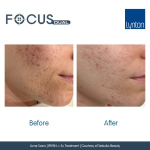 Before and After results of RF Microneedling Treatment