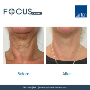 Before & After Focus Dual Treatment