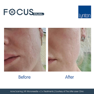 RF Microneedling with Focus Dual Newcastle