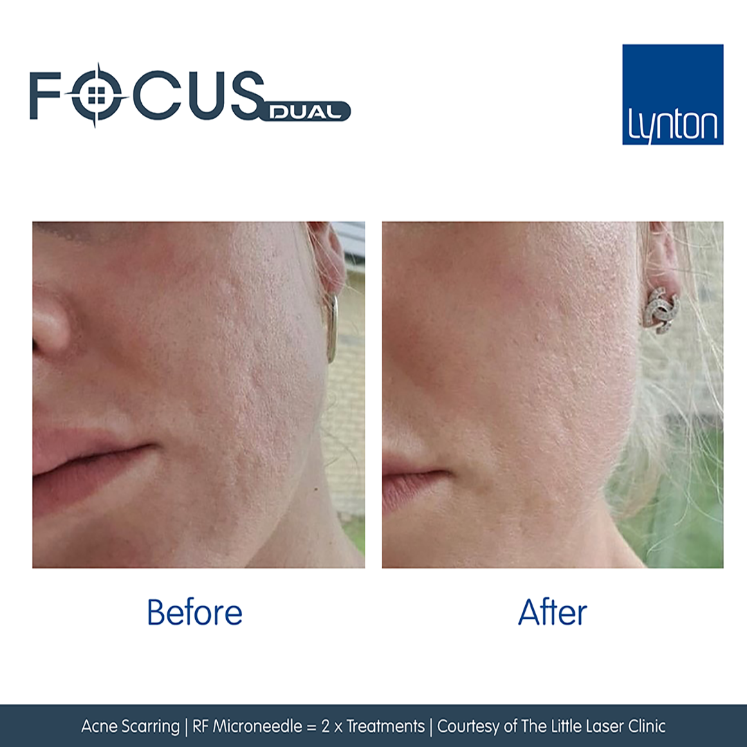 Does RF Microneedling Help With Acne Scars?