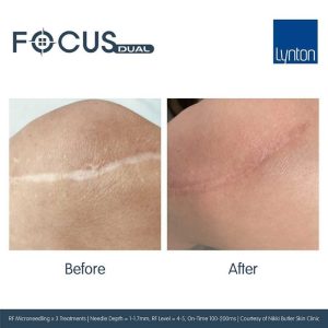 Before and After results of RF Microneedling Treatment