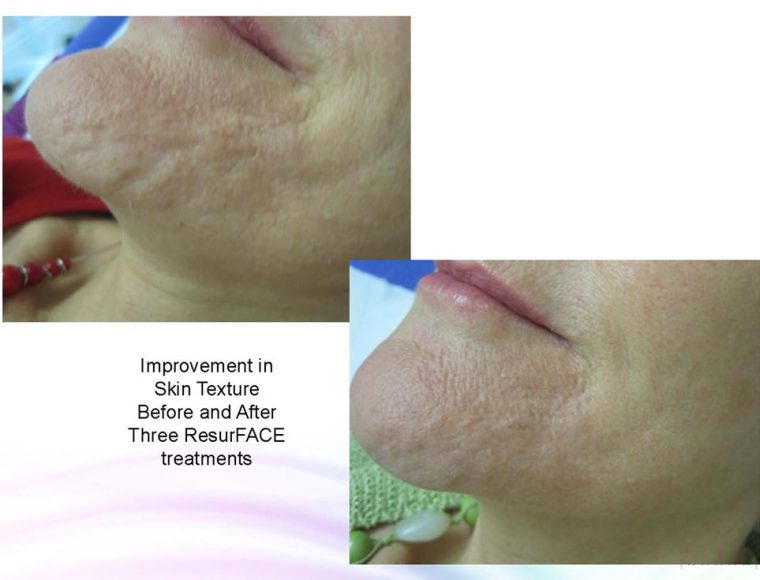 laser acne scar removal before and after