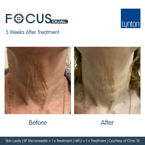 RF Microneedling with Focus Dual Before & After