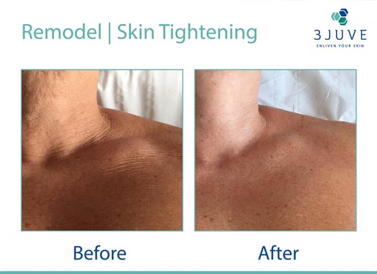 Skin Tightening before & after