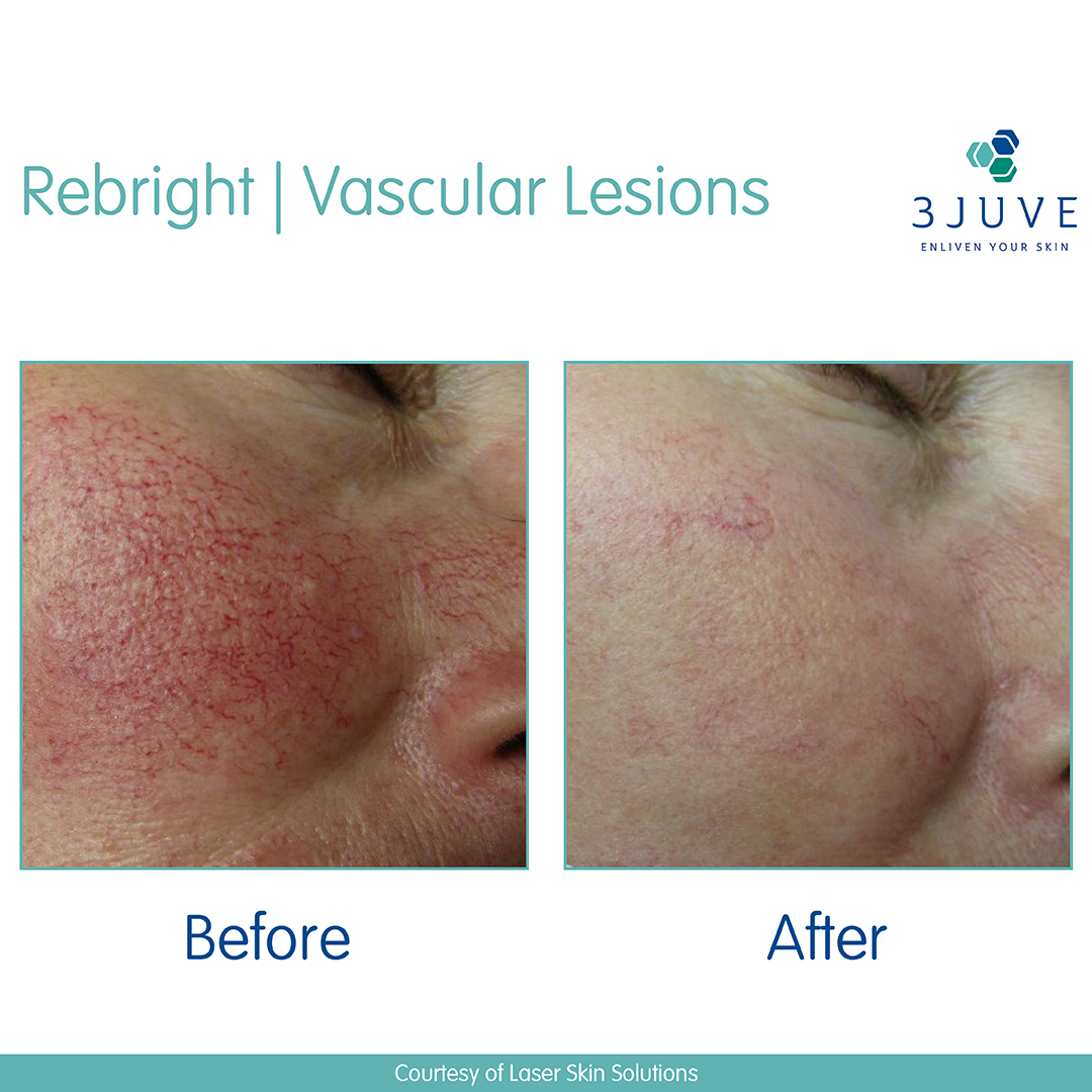 Do Thread Veins Leave You Red-Faced? Intense Pulse Light Therapy (IPL) Can Help