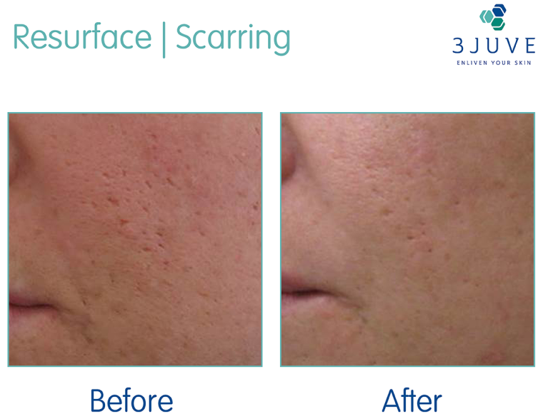 Scar treatment Before / After