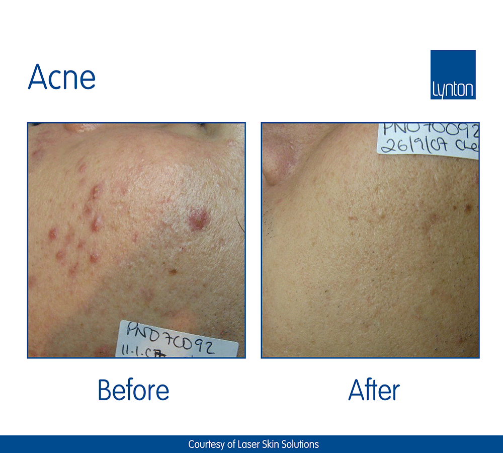 Acne treatment before & after images