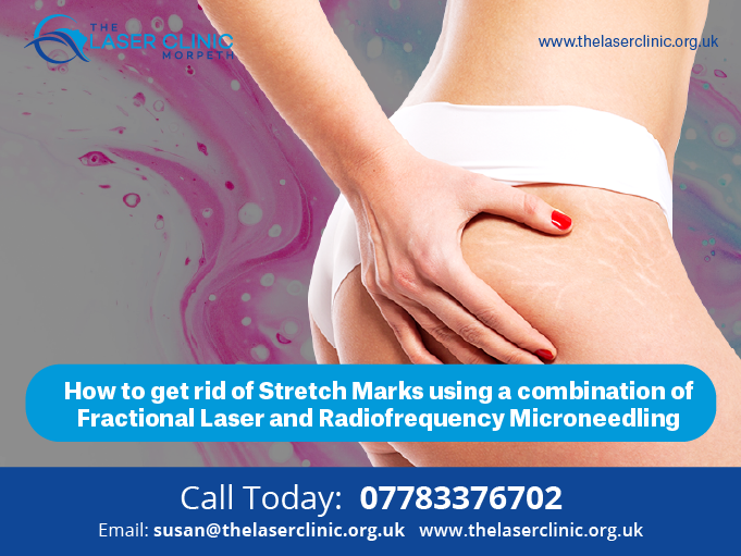 Tackling Crepey Skin and Stretch Marks with Fractional Laser and Radiofrequency Microneedling