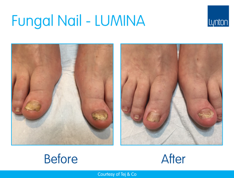 laser toe nail fungus treatment - before and after images