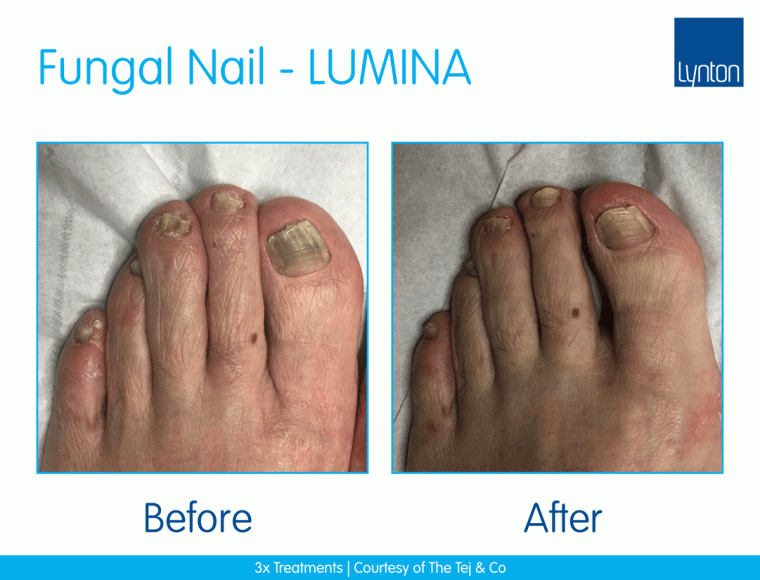 laser-nail-fungus-treatment on toe nails before and after images