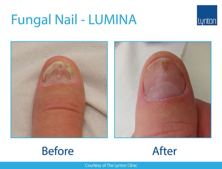 laser nail fungus treatment before and after images