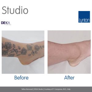 Laser Tattoo Removal before and after images