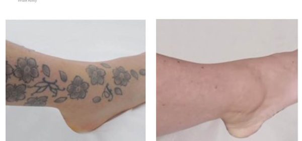 Laser Tattoo Removal before and after images