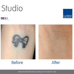 Laser Tattoo Removal - on arm before and after image