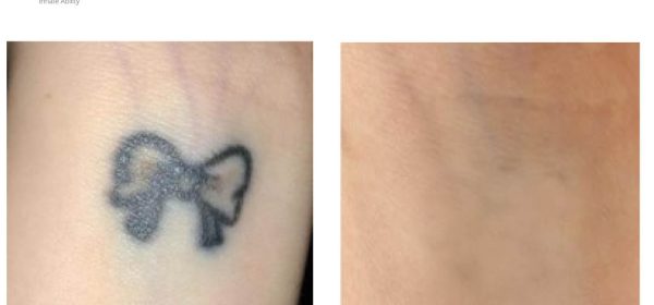 Laser Tattoo Removal - on arm before and after image