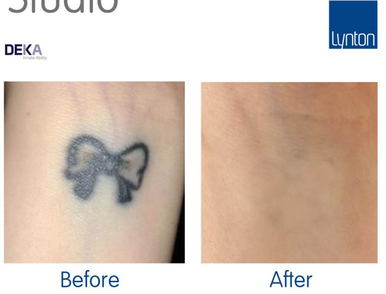 Laser Tattoo Removal - on arm before and after image