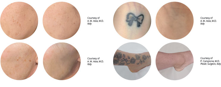 q-switch laser tattoo removal before and after images