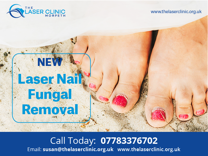 Laser Nail Fungus Treatment Does It Really Work?