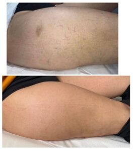leg vein removal treatment