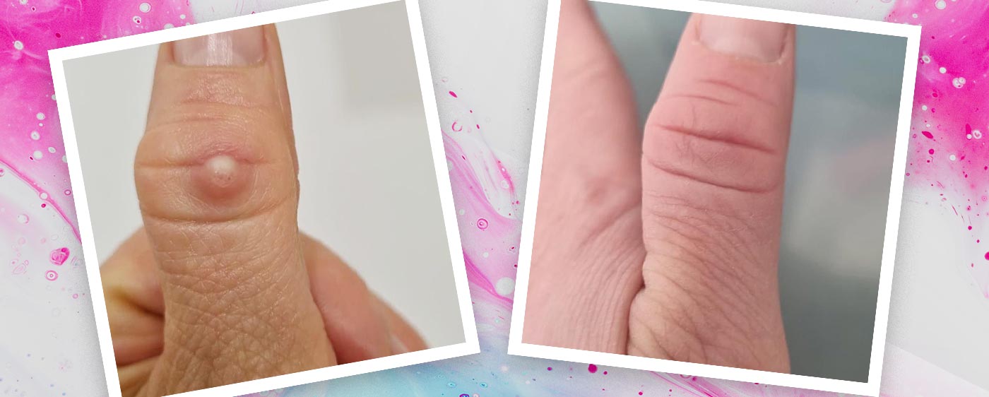 Wart and Verruca Removal